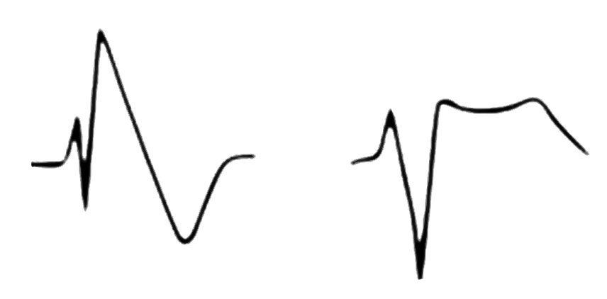 Elektrographische Unterschiede der Brugada-Syndrom-typischen EKGs (EKG-Typ1 und EKG-Typ 2).