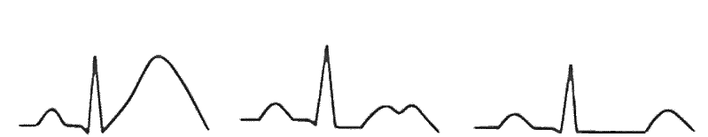 Elektrographische Unterschiede der LQTS-Unterformen Typ1, Typ2 und Ty3. 